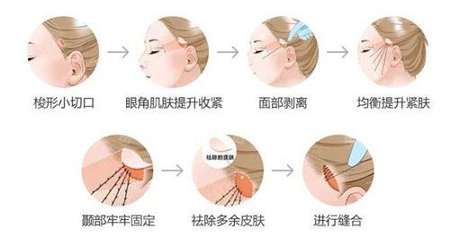 皮肤电凝胶水(皮肤电凝术),第1张 皮肤电凝胶水(皮肤电凝术),皮肤电凝胶水(皮肤电凝术),第1张