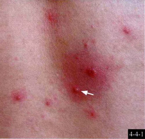 皮肤病图片对照大全查看图片（皮肤病图片对照大全查看图片皮炎）,皮肤病图片对照大全查看图片（皮肤病图片对照大全查看图片皮炎）,第1张