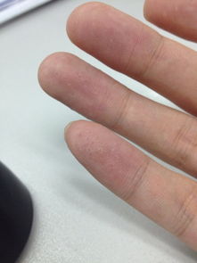 最可怕的皮肤病(最吓人的皮肤病),第2张 最可怕的皮肤病(最吓人的皮肤病),最可怕的皮肤病(最吓人的皮肤病),第2张