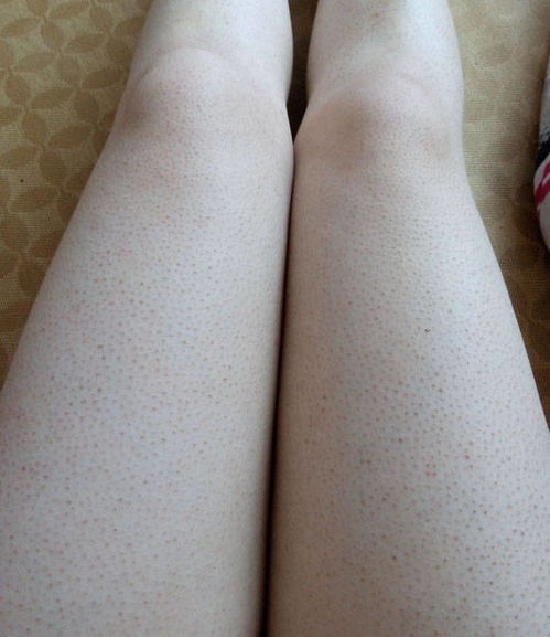 鸡皮肤病因(鸡皮肤的病因),第2张 鸡皮肤病因(鸡皮肤的病因),鸡皮肤病因(鸡皮肤的病因),第2张