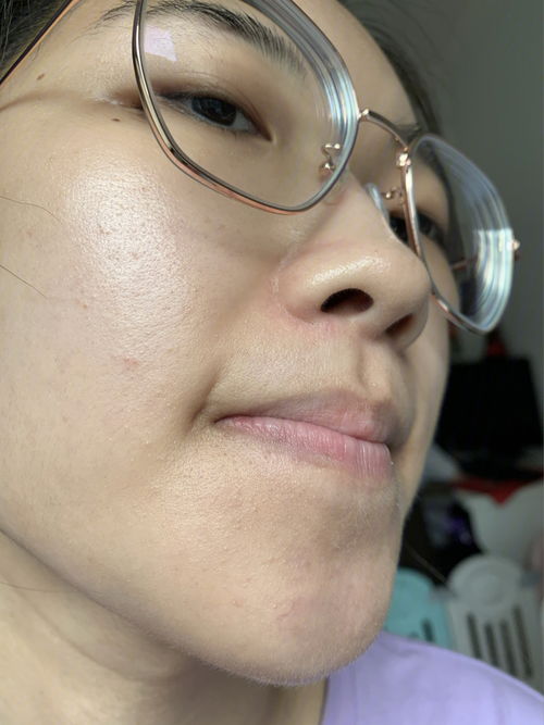 皮肤用护肤品长痘痘（皮肤一用护肤品就过敏怎么办）,皮肤用护肤品长痘痘（皮肤一用护肤品就过敏怎么办）,第2张