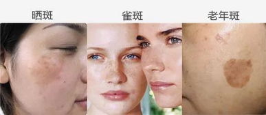 消除皮肤色斑(去除皮肤色斑的中药有哪些),第3张 消除皮肤色斑(去除皮肤色斑的中药有哪些),消除皮肤色斑(去除皮肤色斑的中药有哪些),第3张