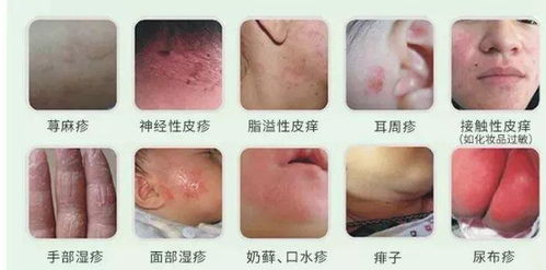 最可怕的皮肤病(最吓人的皮肤病),第3张 最可怕的皮肤病(最吓人的皮肤病),最可怕的皮肤病(最吓人的皮肤病),第3张