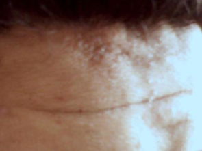 头上皮肤康诊怎样回事(头上皮肤病),第2张 头上皮肤康诊怎样回事(头上皮肤病),头上皮肤康诊怎样回事(头上皮肤病),第2张