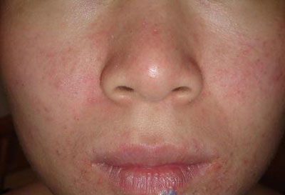 脸上皮肤反复瘙痒怎么办(脸上皮肤一直痒怎么办),第1张 脸上皮肤反复瘙痒怎么办(脸上皮肤一直痒怎么办),脸上皮肤反复瘙痒怎么办(脸上皮肤一直痒怎么办),第1张