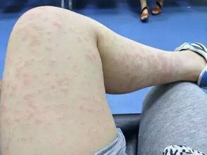 春天秋天皮肤过敏(春天秋天皮肤过敏什么原因),第2张 春天秋天皮肤过敏(春天秋天皮肤过敏什么原因),春天秋天皮肤过敏(春天秋天皮肤过敏什么原因),第2张