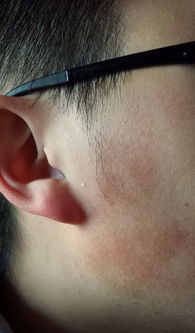 皮肤色素沉着怎么内调和治疗(皮肤色素沉着斑块怎么回事),第2张 皮肤色素沉着怎么内调和治疗(皮肤色素沉着斑块怎么回事),皮肤色素沉着怎么内调和治疗(皮肤色素沉着斑块怎么回事),第2张