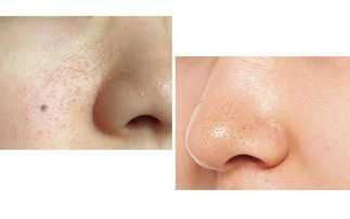 毛孔在皮肤哪一层(毛孔长在皮肤哪一层),第3张 毛孔在皮肤哪一层(毛孔长在皮肤哪一层),毛孔在皮肤哪一层(毛孔长在皮肤哪一层),第3张