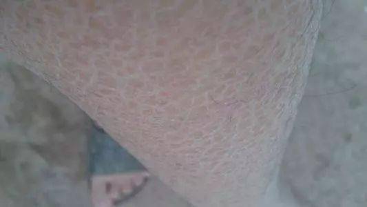 小腿皮肤鱼鳞偏方(糖尿病小腿皮肤像鱼鳞),第1张 小腿皮肤鱼鳞偏方(糖尿病小腿皮肤像鱼鳞),小腿皮肤鱼鳞偏方(糖尿病小腿皮肤像鱼鳞),第1张