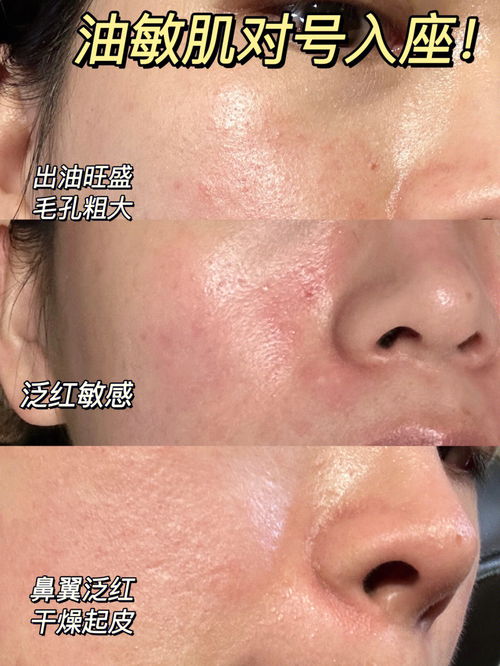 皮肤敏感又长斑怎么办(皮肤敏了),第1张 皮肤敏感又长斑怎么办(皮肤敏了),皮肤敏感又长斑怎么办(皮肤敏了),第1张