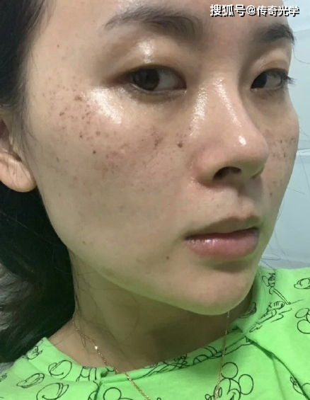 点阵激光恢复正常皮肤(点阵激光皮肤多久能恢复正常),第1张 点阵激光恢复正常皮肤(点阵激光皮肤多久能恢复正常),点阵激光恢复正常皮肤(点阵激光皮肤多久能恢复正常),第1张