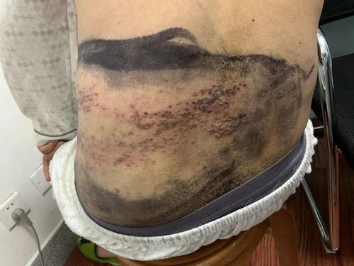 最可怕的皮肤病(最吓人的皮肤病),第1张 最可怕的皮肤病(最吓人的皮肤病),最可怕的皮肤病(最吓人的皮肤病),第1张