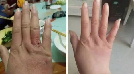 冻手怎么办(天一冷就冻手怎么办),第3张 冻手怎么办(天一冷就冻手怎么办),冻手怎么办(天一冷就冻手怎么办),第3张