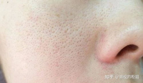 皮肤过敏后留下黑色素(皮肤过敏留下黑色素沉淀),第2张 皮肤过敏后留下黑色素(皮肤过敏留下黑色素沉淀),皮肤过敏后留下黑色素(皮肤过敏留下黑色素沉淀),第2张