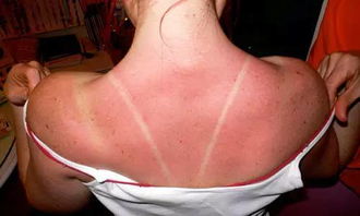 皮肤晒伤剥皮正常么(皮肤晒伤脱皮怎么修复小妙招),第3张 皮肤晒伤剥皮正常么(皮肤晒伤脱皮怎么修复小妙招),皮肤晒伤剥皮正常么(皮肤晒伤脱皮怎么修复小妙招),第3张