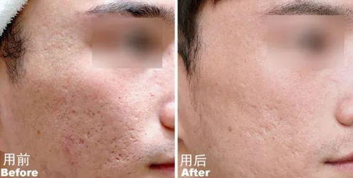 改善脸皮肤男(让脸脱皮能不能改善皮肤),第3张 改善脸皮肤男(让脸脱皮能不能改善皮肤),改善脸皮肤男(让脸脱皮能不能改善皮肤),第3张