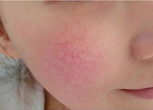 皮肤起了包痒有干皮(皮肤痒还有包),第3张 皮肤起了包痒有干皮(皮肤痒还有包),皮肤起了包痒有干皮(皮肤痒还有包),第3张