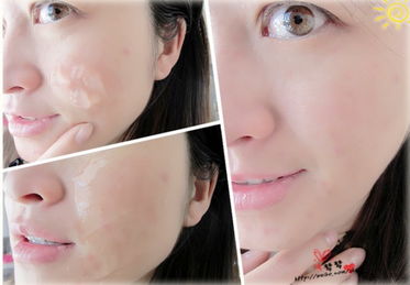 挤痘伤了皮肤怎么办(挤痘后周围皮肤红怎么办),第1张 挤痘伤了皮肤怎么办(挤痘后周围皮肤红怎么办),挤痘伤了皮肤怎么办(挤痘后周围皮肤红怎么办),第1张