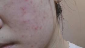 面部皮肤炎症表现（面部皮肤炎症吃什么消炎药）,面部皮肤炎症表现（面部皮肤炎症吃什么消炎药）,第3张