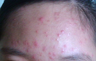 皮肤过敏能用bb(皮肤过敏能用百多邦吗),第1张 皮肤过敏能用bb(皮肤过敏能用百多邦吗),皮肤过敏能用bb(皮肤过敏能用百多邦吗),第1张