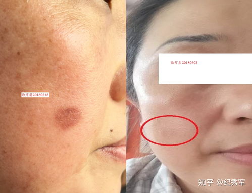 皮肤色素沉着怎么内调和治疗(皮肤色素沉着斑块怎么回事),第1张 皮肤色素沉着怎么内调和治疗(皮肤色素沉着斑块怎么回事),皮肤色素沉着怎么内调和治疗(皮肤色素沉着斑块怎么回事),第1张