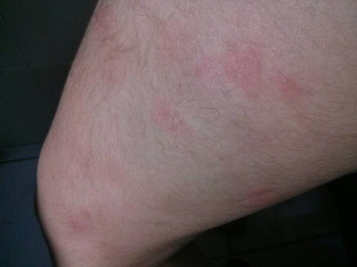 夏天皮肤过敏瘙痒怎么办(夏天皮肤过敏瘙痒怎么办呢),第1张 夏天皮肤过敏瘙痒怎么办(夏天皮肤过敏瘙痒怎么办呢),夏天皮肤过敏瘙痒怎么办(夏天皮肤过敏瘙痒怎么办呢),第1张