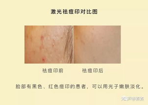 点阵后用什么修复皮肤（皮肤点阵过后用什么?）,点阵后用什么修复皮肤（皮肤点阵过后用什么?）,第3张