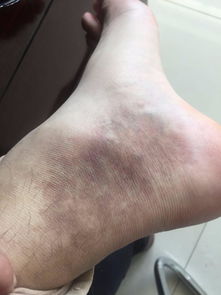 手术后皮肤（手术后皮肤发黑的原因）,手术后皮肤（手术后皮肤发黑的原因）,第3张