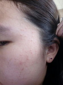 脸上皮肤反复瘙痒怎么办(脸上皮肤一直痒怎么办),第3张 脸上皮肤反复瘙痒怎么办(脸上皮肤一直痒怎么办),脸上皮肤反复瘙痒怎么办(脸上皮肤一直痒怎么办),第3张