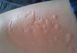 皮肤过敏是全身痒吗(皮肤过敏是不是痒),第1张 皮肤过敏是全身痒吗(皮肤过敏是不是痒),皮肤过敏是全身痒吗(皮肤过敏是不是痒),第1张