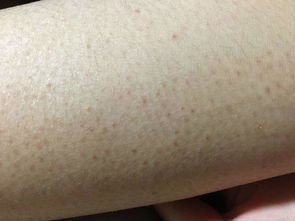 鸡皮肤病因(鸡皮肤的病因),第3张 鸡皮肤病因(鸡皮肤的病因),鸡皮肤病因(鸡皮肤的病因),第3张