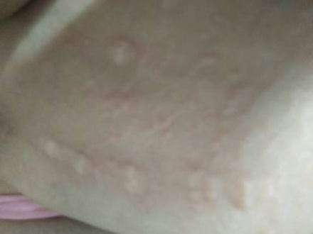 产后的皮肤(产后皮肤痒抓就起疙瘩),第2张 产后的皮肤(产后皮肤痒抓就起疙瘩),产后的皮肤(产后皮肤痒抓就起疙瘩),第2张