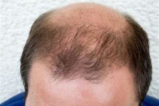 脱发吃什么好(男人脱发吃什么好),第1张 脱发吃什么好(男人脱发吃什么好),脱发吃什么好(男人脱发吃什么好),第1张