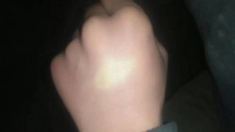 皮肤萎缩有什么症状(皮肤萎缩能恢复正常吗),第3张 皮肤萎缩有什么症状(皮肤萎缩能恢复正常吗),皮肤萎缩有什么症状(皮肤萎缩能恢复正常吗),第3张