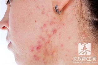 敏感皮肤如何去痘印（如何加快皮肤代谢去痘印）,敏感皮肤如何去痘印（如何加快皮肤代谢去痘印）,第1张