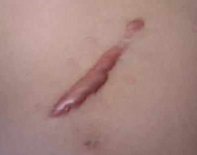 皮肤萎缩有什么症状(皮肤萎缩能恢复正常吗),第1张 皮肤萎缩有什么症状(皮肤萎缩能恢复正常吗),皮肤萎缩有什么症状(皮肤萎缩能恢复正常吗),第1张