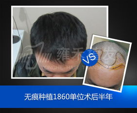 有疤的皮肤能种植毛发吗(疤痕处能不能植发),第3张 有疤的皮肤能种植毛发吗(疤痕处能不能植发),有疤的皮肤能种植毛发吗(疤痕处能不能植发),第3张