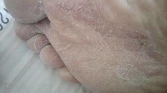 偏方治脚气(偏方治脚气效果最好),第2张 偏方治脚气(偏方治脚气效果最好),偏方治脚气(偏方治脚气效果最好),第2张