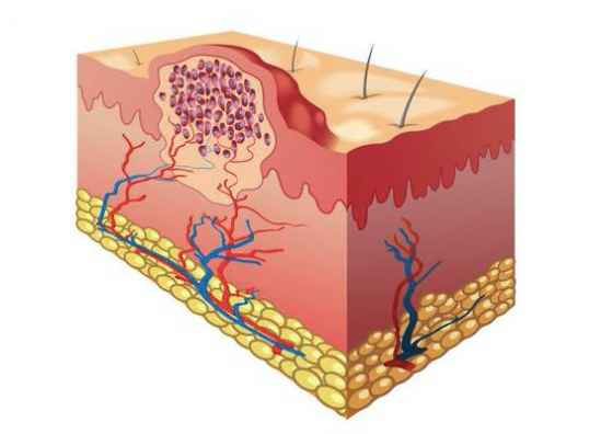 皮肤吸收方式（皮肤吸收原理）,皮肤吸收方式（皮肤吸收原理）,第2张