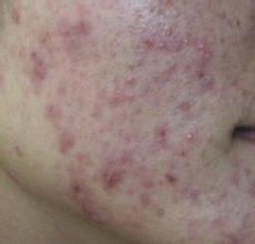 皮肤粉刺是什么(皮肤粉刺是什么样的),第2张 皮肤粉刺是什么(皮肤粉刺是什么样的),皮肤粉刺是什么(皮肤粉刺是什么样的),第2张