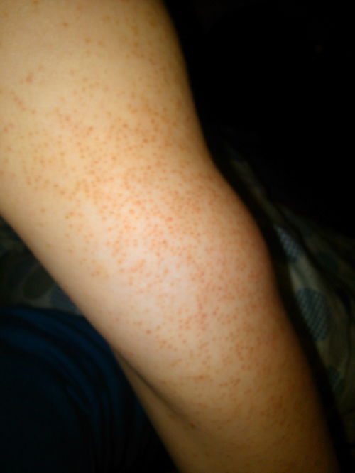 后背皮肤毛囊炎（后背毛囊炎很痒怎么办）,后背皮肤毛囊炎（后背毛囊炎很痒怎么办）,第2张