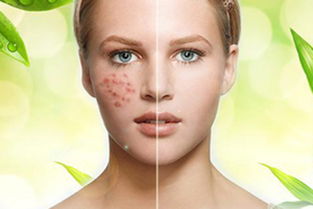 痘痘周边的皮肤腐烂(痘痘周围起皮是要好了吗),第2张 痘痘周边的皮肤腐烂(痘痘周围起皮是要好了吗),痘痘周边的皮肤腐烂(痘痘周围起皮是要好了吗),第2张