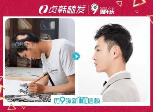 有疤的皮肤能种植毛发吗(疤痕处能不能植发),第2张 有疤的皮肤能种植毛发吗(疤痕处能不能植发),有疤的皮肤能种植毛发吗(疤痕处能不能植发),第2张