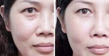 额角皮肤浅(额角皮肤凹陷是什么原因),第1张 额角皮肤浅(额角皮肤凹陷是什么原因),额角皮肤浅(额角皮肤凹陷是什么原因),第1张