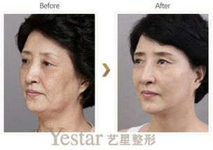 点阵激光恢复正常皮肤(点阵激光皮肤多久能恢复正常),第2张 点阵激光恢复正常皮肤(点阵激光皮肤多久能恢复正常),点阵激光恢复正常皮肤(点阵激光皮肤多久能恢复正常),第2张