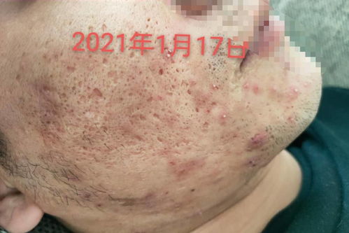 皮肤萎缩有什么症状(皮肤萎缩能恢复正常吗),第2张 皮肤萎缩有什么症状(皮肤萎缩能恢复正常吗),皮肤萎缩有什么症状(皮肤萎缩能恢复正常吗),第2张