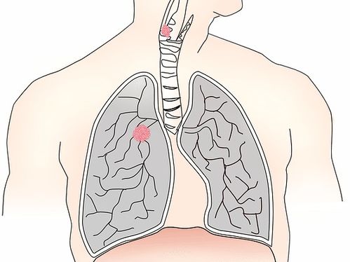 肺结核传染途径(肺结核传染途径是什么),第1张 肺结核传染途径(肺结核传染途径是什么),肺结核传染途径(肺结核传染途径是什么),第1张