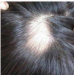 脱发吃什么好(男人脱发吃什么好),第2张 脱发吃什么好(男人脱发吃什么好),脱发吃什么好(男人脱发吃什么好),第2张