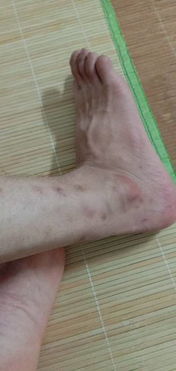 痘痘周边的皮肤腐烂(痘痘周围起皮是要好了吗),第1张 痘痘周边的皮肤腐烂(痘痘周围起皮是要好了吗),痘痘周边的皮肤腐烂(痘痘周围起皮是要好了吗),第1张