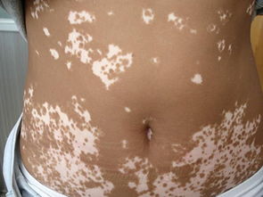 皮肤黑色素异常(皮肤黑色素功能丧失是为什么),第3张 皮肤黑色素异常(皮肤黑色素功能丧失是为什么),皮肤黑色素异常(皮肤黑色素功能丧失是为什么),第3张